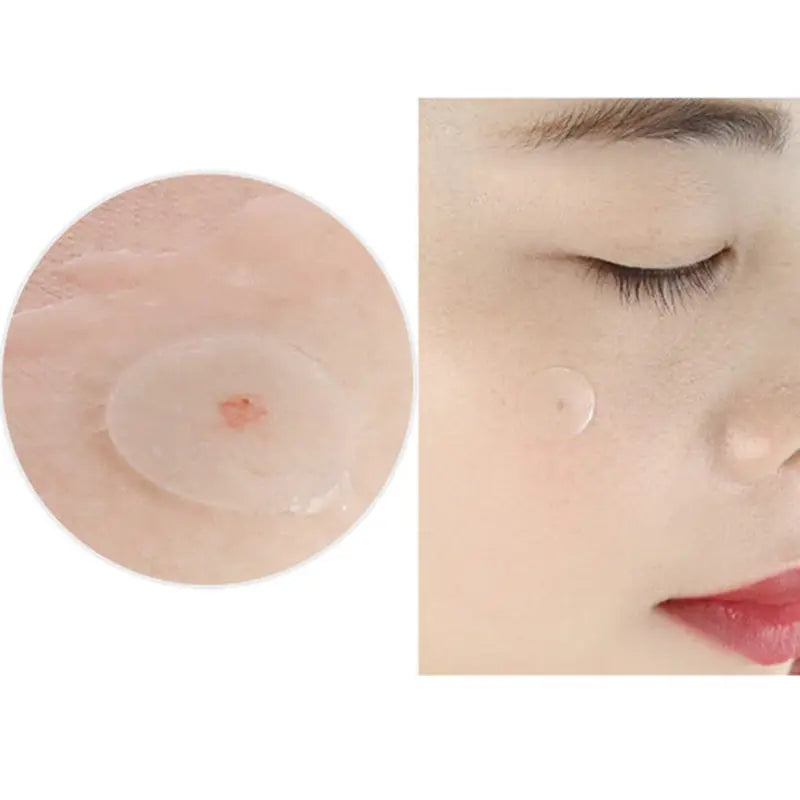 24/36 stücke Akne Pickel Patch Unsichtbare Effiziente Makel Schutzhülle Zit Aufkleber für Akne Spot Behandlung Hautpflege Werkzeug TK - So ist Leben
